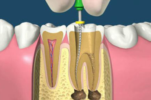 Endodoncija